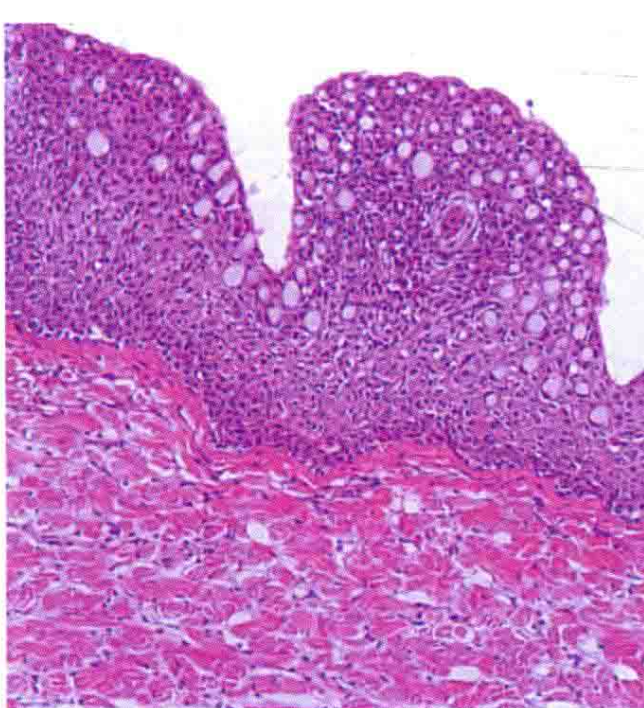 The transverse of upper lip